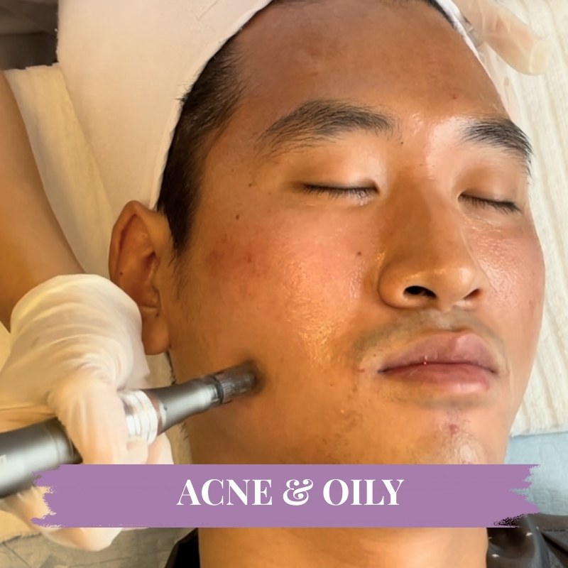 Micro-needling & Skin Boosters
